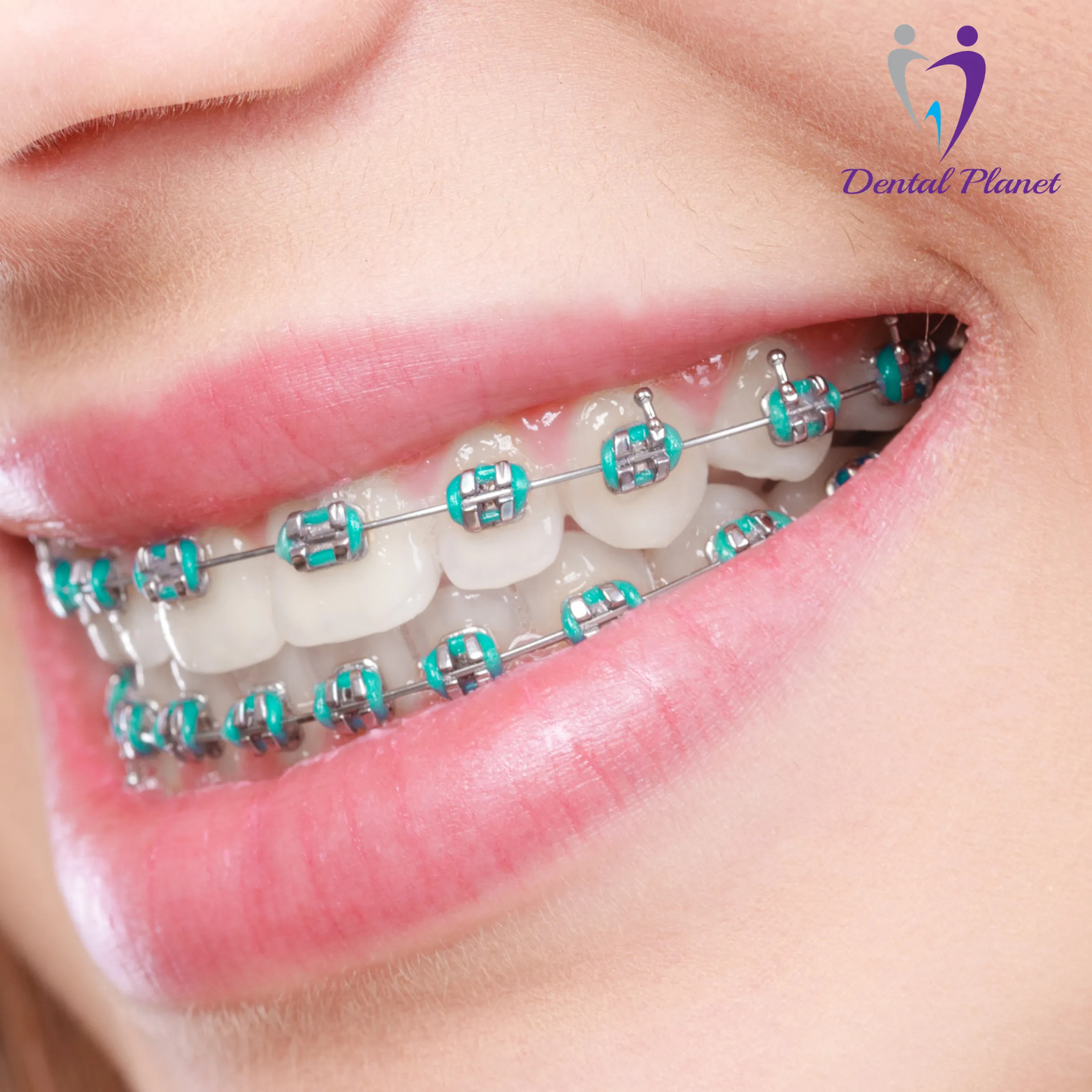 Traditional Metal Braces - Dental Planet